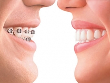 teeth_alignment