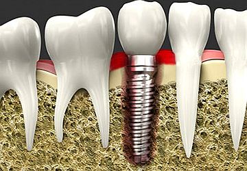 Dental Implant Problem