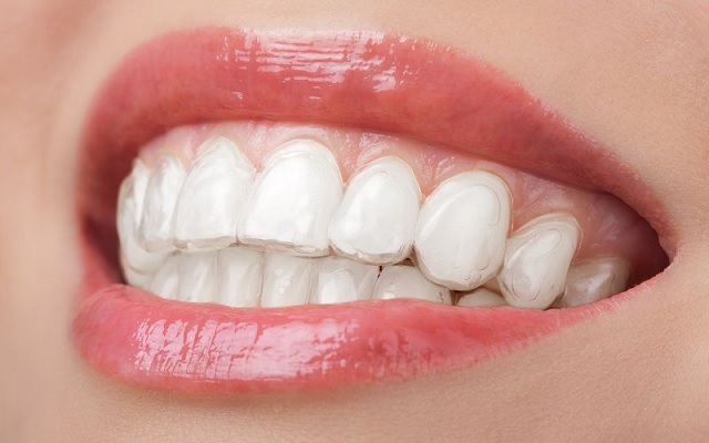 Transparent Orthodontics