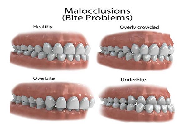 Dental-Malocclusions